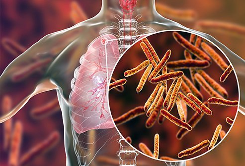 health-series-tuberculosis-types-symptoms-diagnosis-and-treatment-blurt